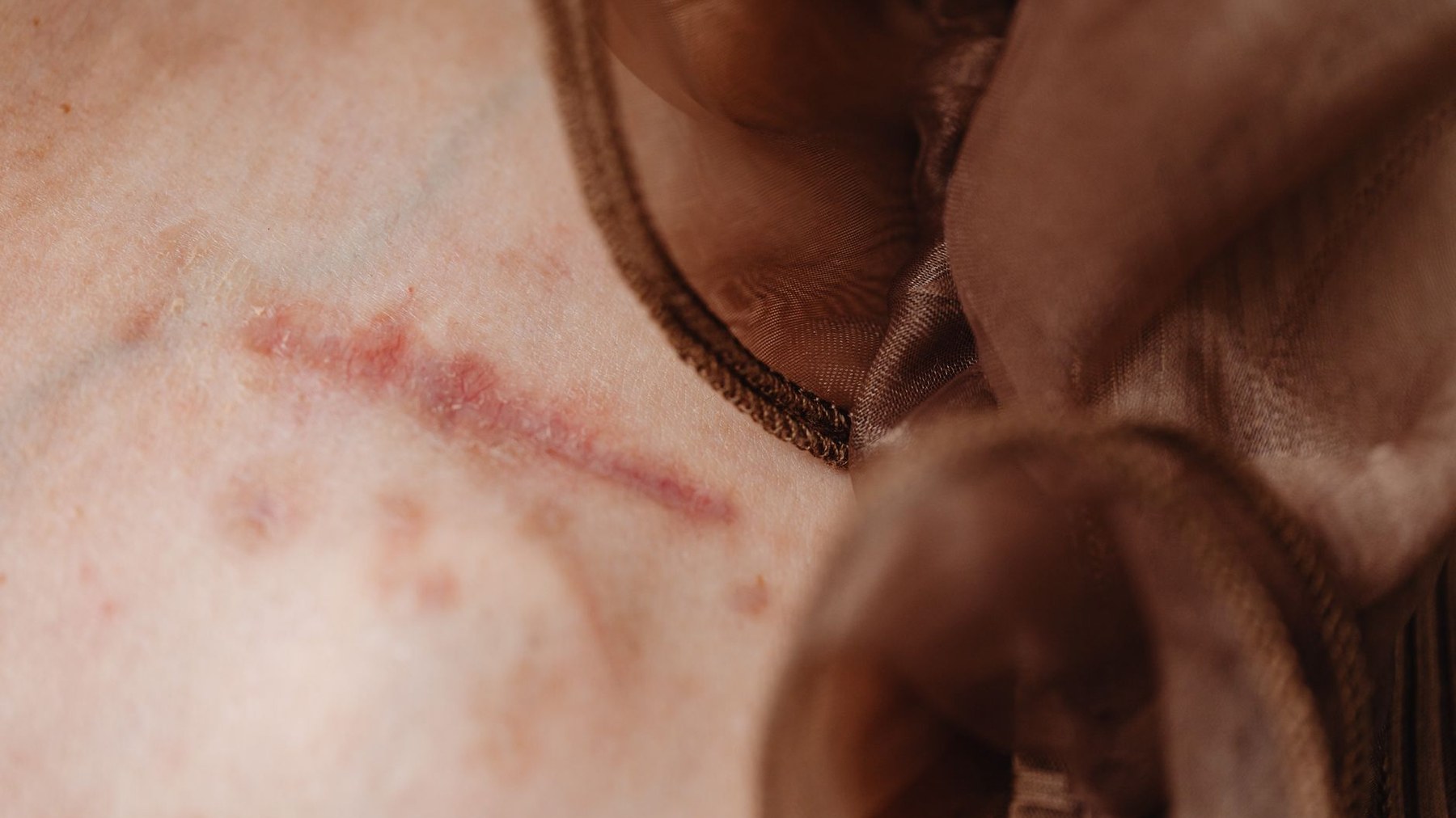 Cicatrice après laparotomie : soins, surveillance et reprise progressive